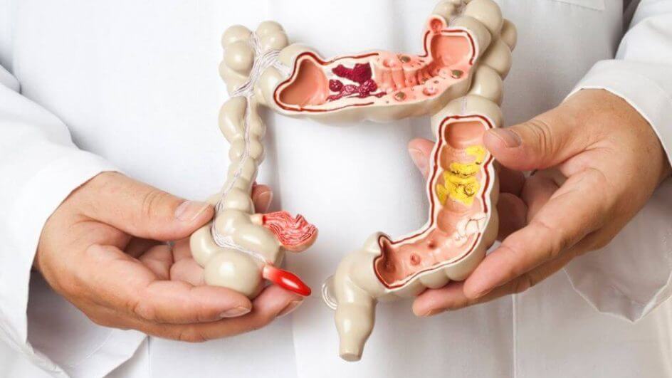 Câncer de intestino