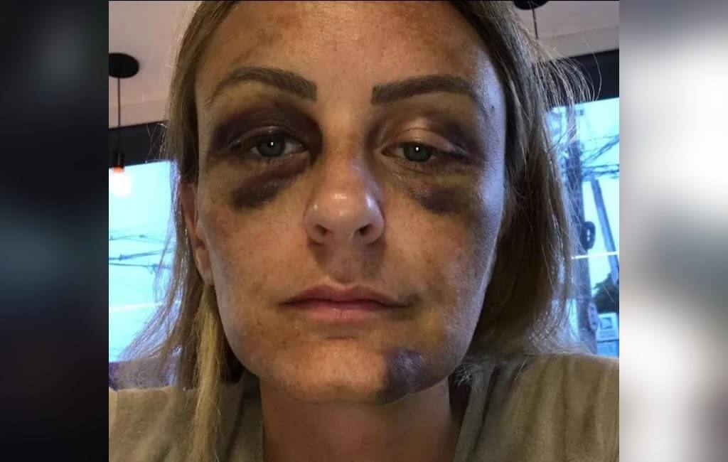 Ela conta que agressão fez com que o relacionamento terminasse (Foto: Reprodução/Redes sociais)