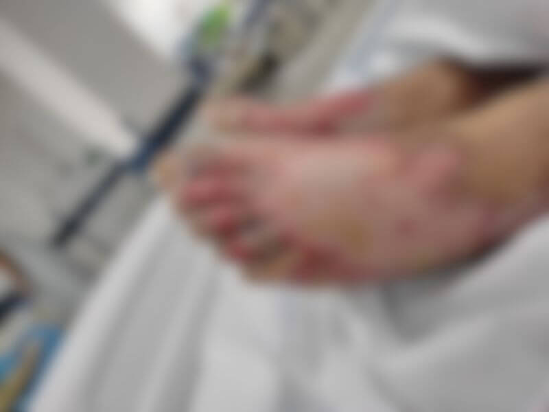 Menino sofreu queimaduras de terceiro grau nos pés e em outras partes do corpo