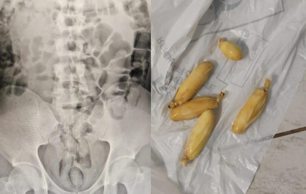 Cocaína foi encontrada dentro do estômago do suspeito