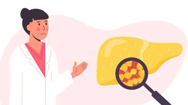 Ilustração de médica ao lado de um fígado gorduroso