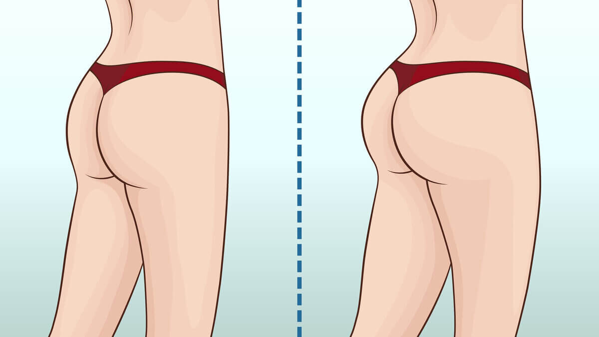 Ilustração de um bumbum antes e após procedimento estético 