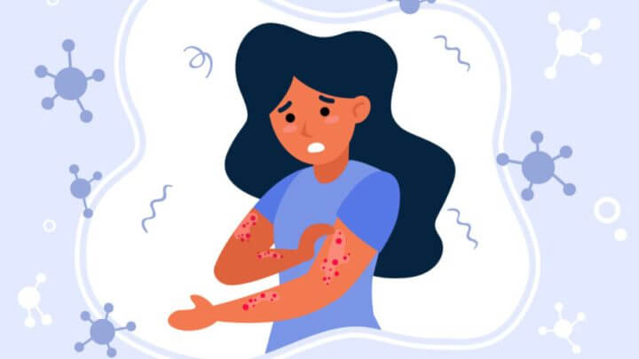 Ilustração de mulher sofrendo com psoríase
