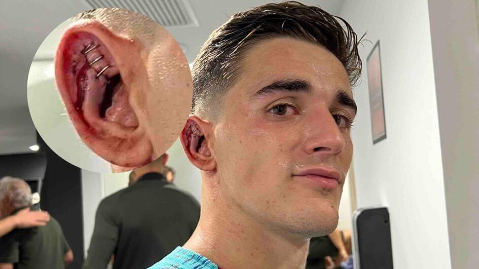 Cem jogos e cinco grampos na orelha.gavi barcelona