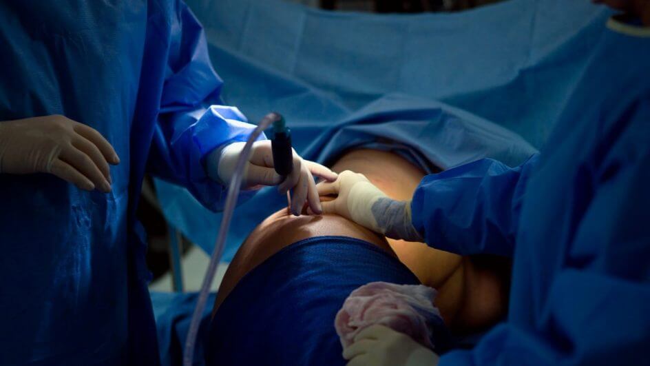 Lipoaspiração Ugraft