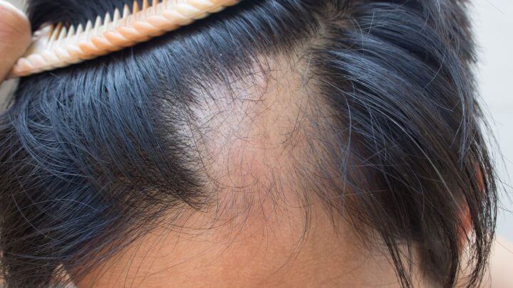Veja remédios eficazes contra queda de cabelo