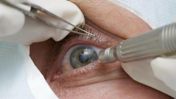 Fungo infectou 104 pacientes após mutirão de cirurgia contra catarata