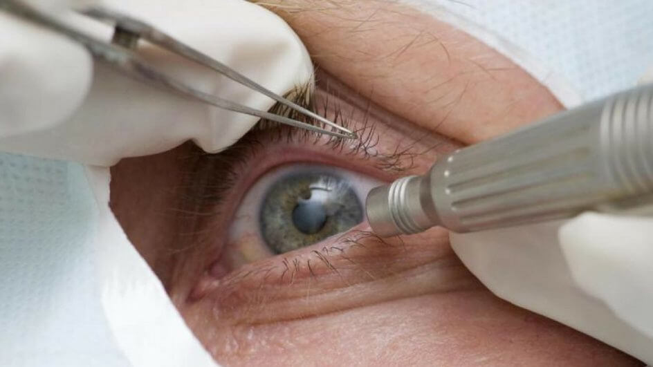 Fungo infectou 104 pacientes após mutirão de cirurgia contra catarata