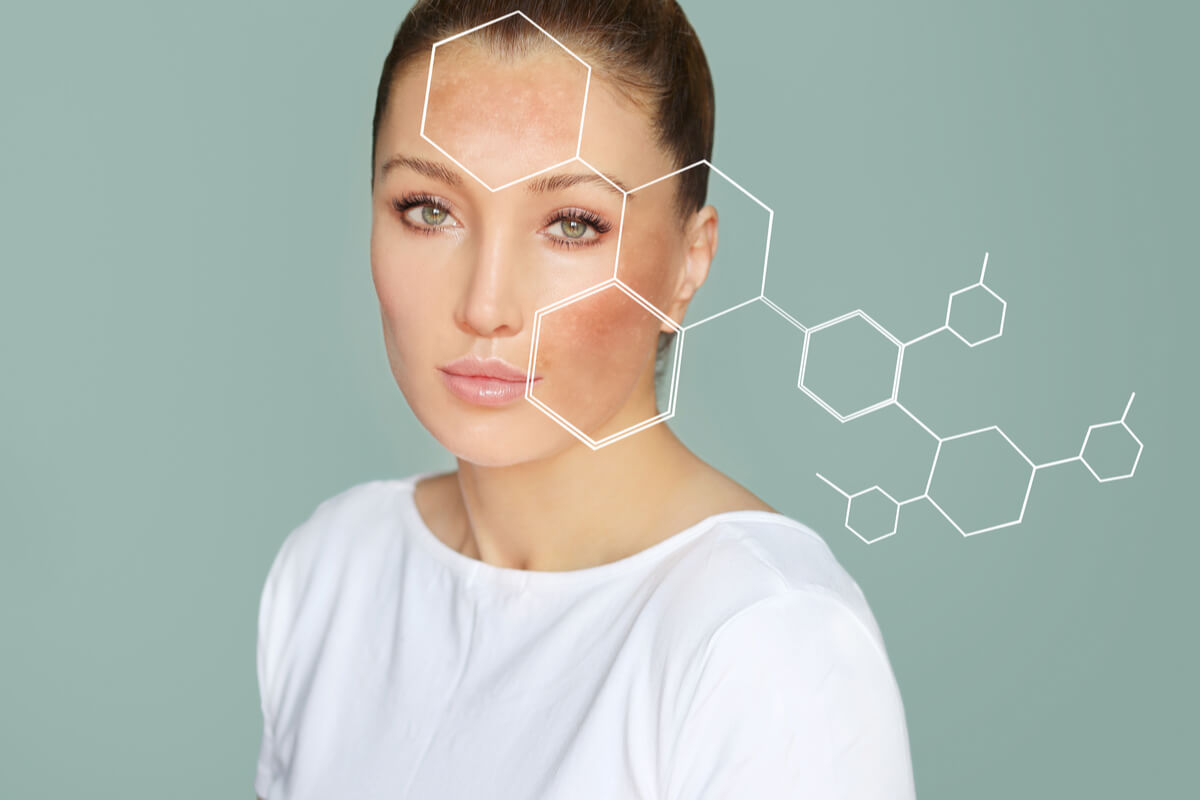 As manchas do melasma podem estar ligadas a alterações hormonais e ser desencadeadas pela luz solar (Imagem: LADO | Shutterstock)