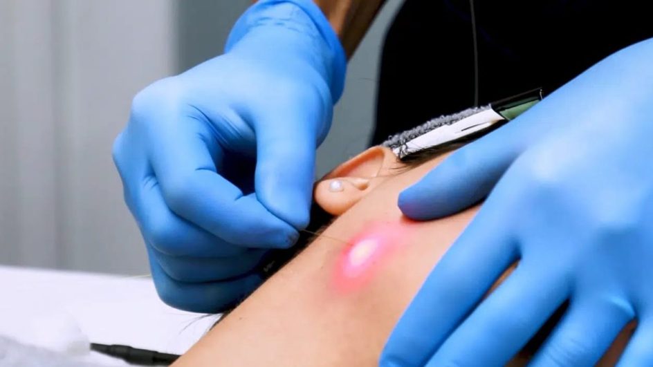 Endolaser - La Clinic Saúde e Estética (Foto: Divulgação)