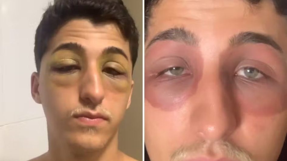 Rapaz moreno jovem com região dos olhos arroxeadas