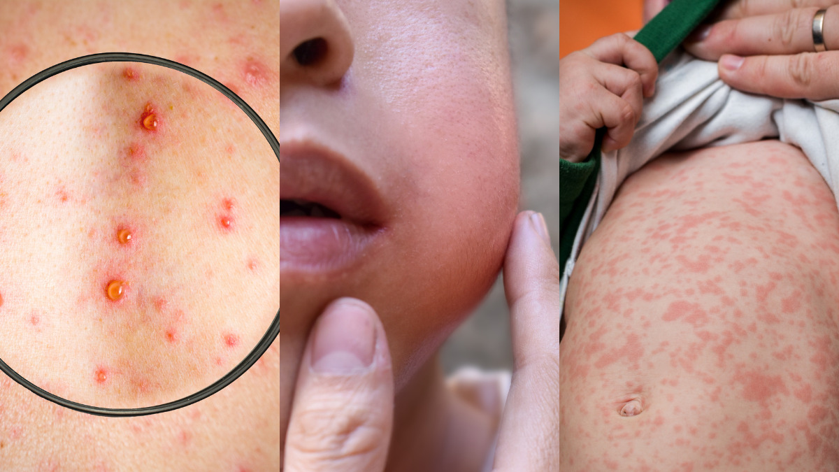 vacinas para adolescentes