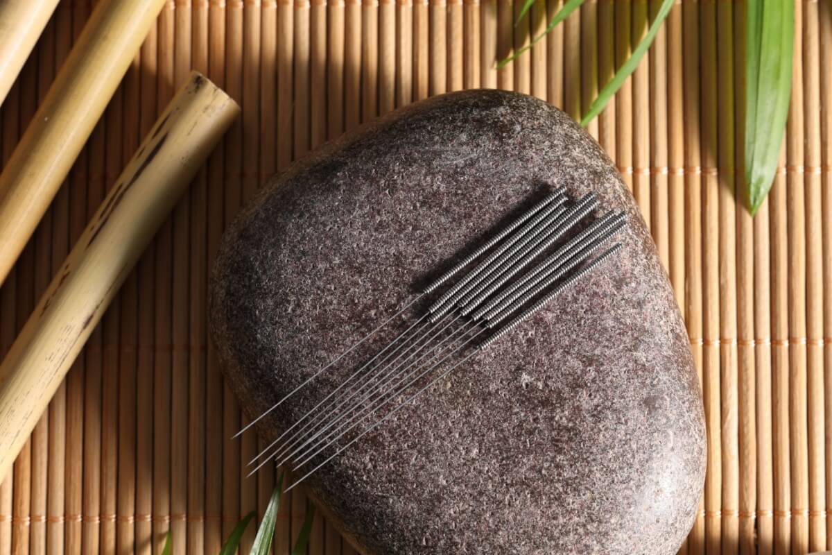 Acupuntura é um tratamento alternativo para a cefaleia (Imagem: New Africa | Shutterstock)
