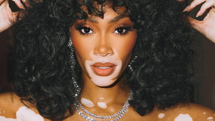 Dia Mundial do Vitiligo