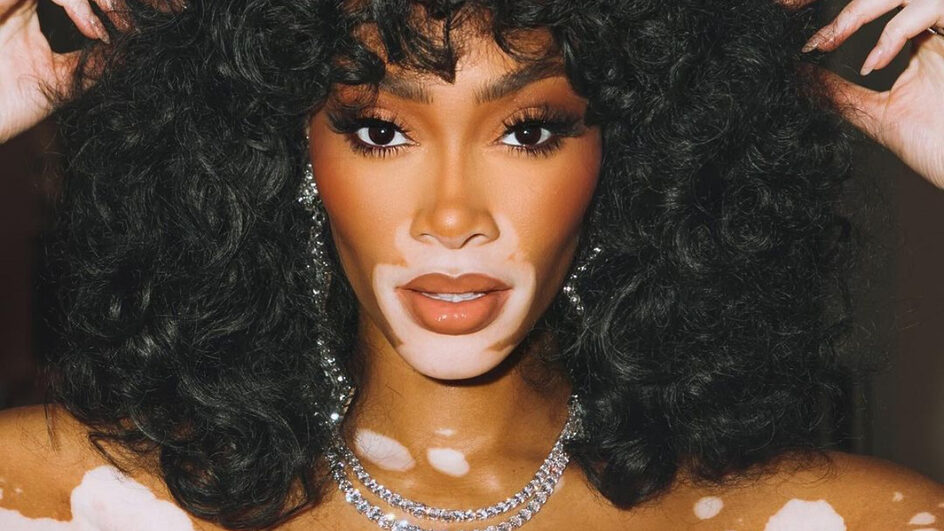 Dia Mundial do Vitiligo