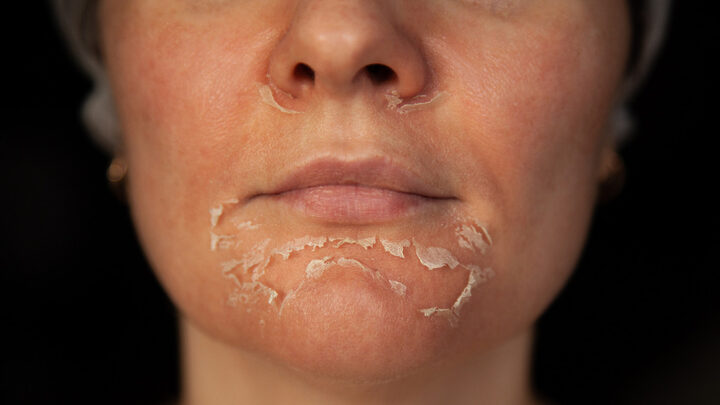 peeling de fenol