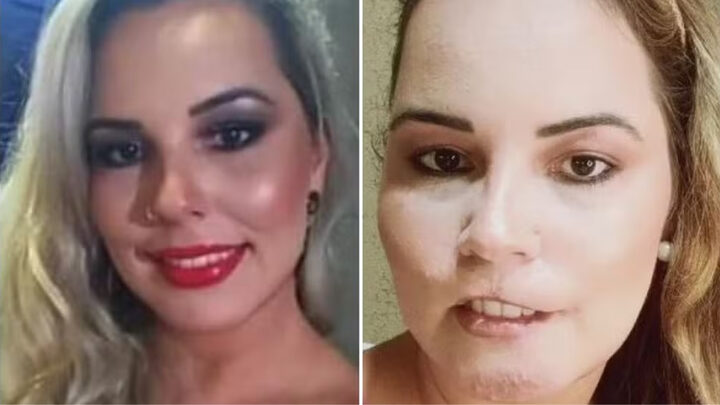 Processo de reconstrução do rosto de influencer que perdeu o lábio