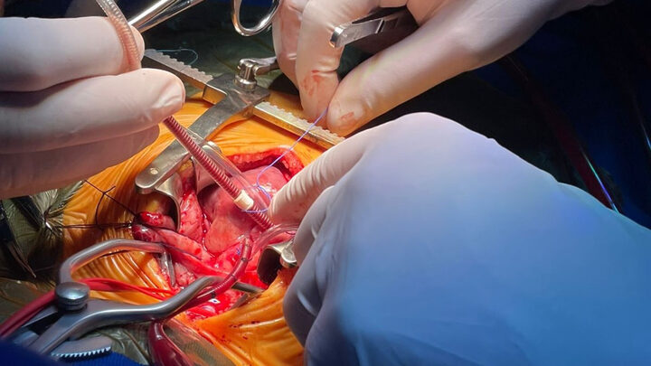 SC realiza cirurgia inédita para tratar condição congênita rara em bebê de três meses