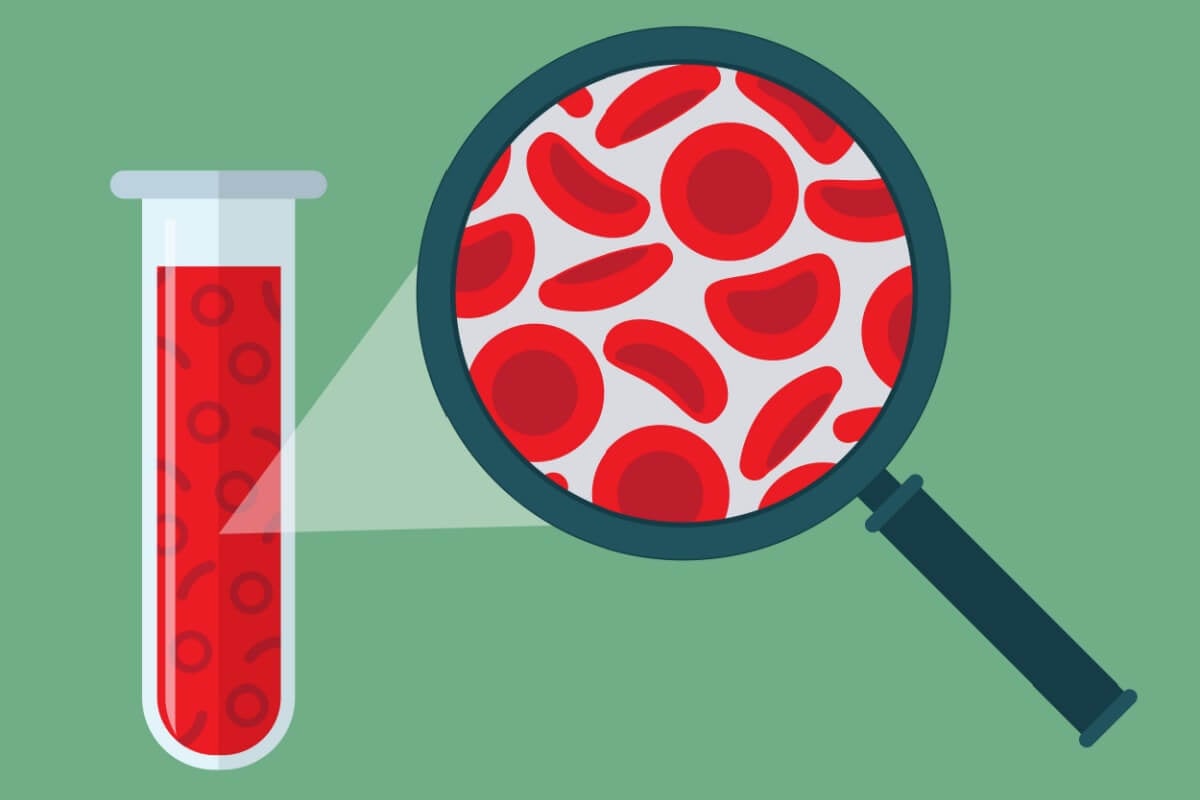 A doença falciforme é uma patologia que atinge o sangue (Imagem: Andy Frith | Shutterstock)