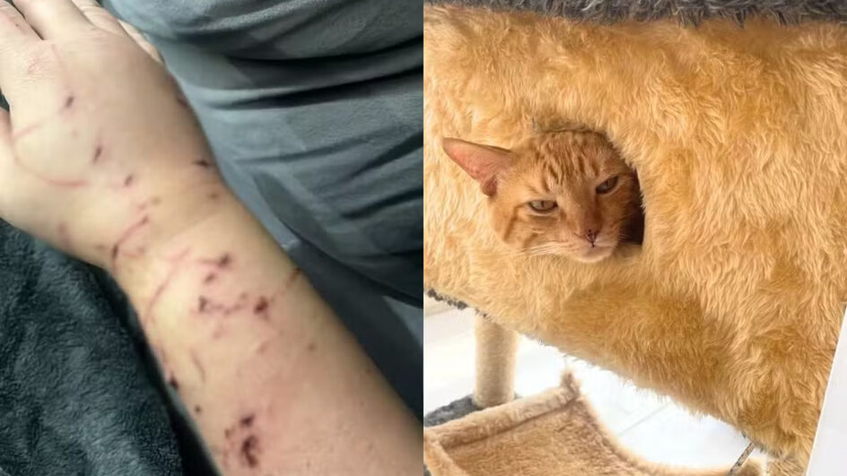 Braço dilacerado após ataque do gato Thor