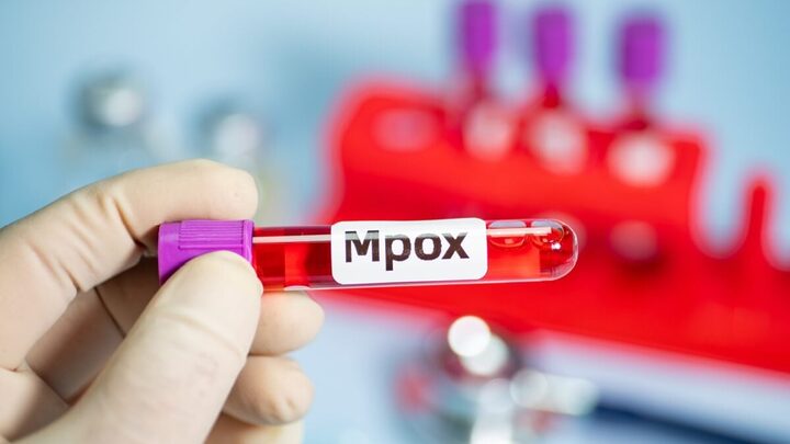 A mpox é uma doença viral transmitida por contato direto com lesões ou superfícies contaminadas (Imagem: QINQIE99 | Shutterstock)