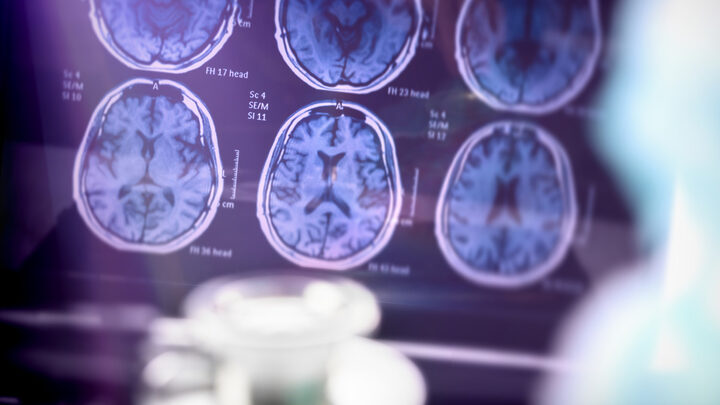 Alzheimer pesquisadores desenvolvem remédio “inovador” que ajuda prevenir progressão da doença