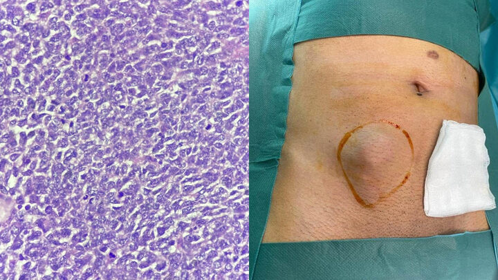 sarcoma sinovial