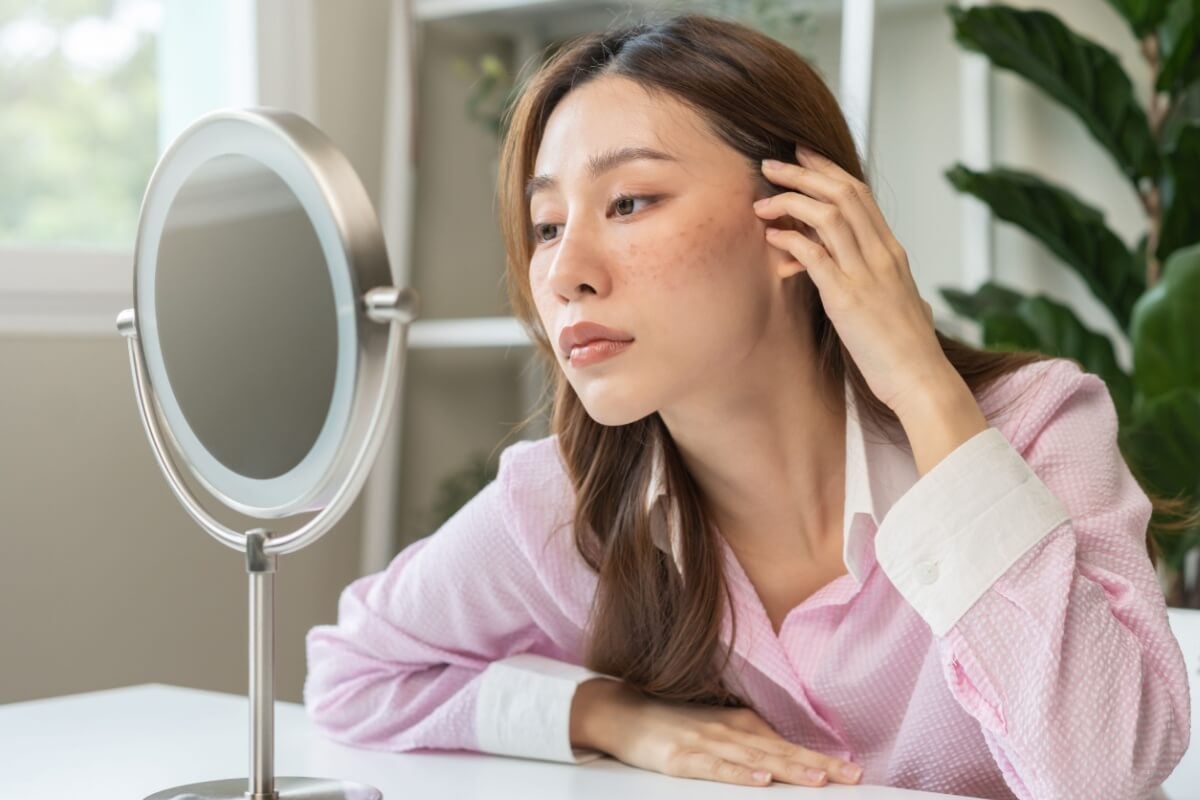 O melasma pode ser desencadeado por diversos fatores (Imagem: Kmpzzz | Shutterstock)