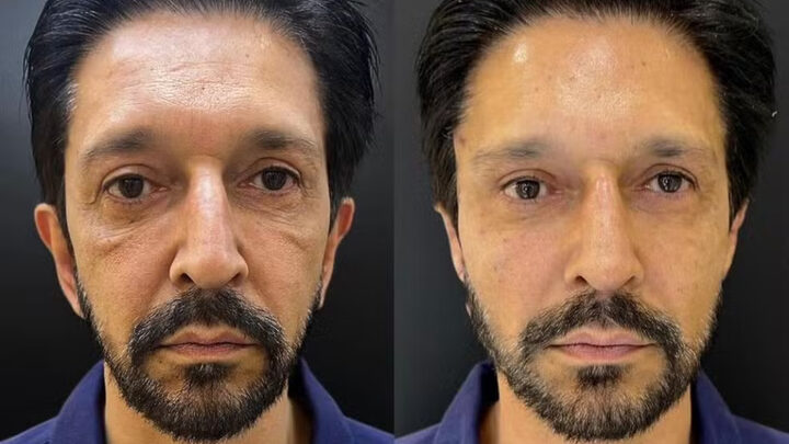 Ricardo Nunes harmonização facial