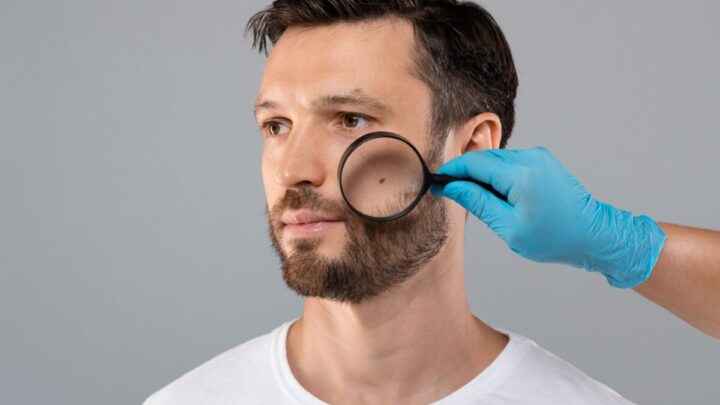 Algumas pintas na pele podem ser câncer de pele (Imagem: Prostock-studio | Shutterstock)