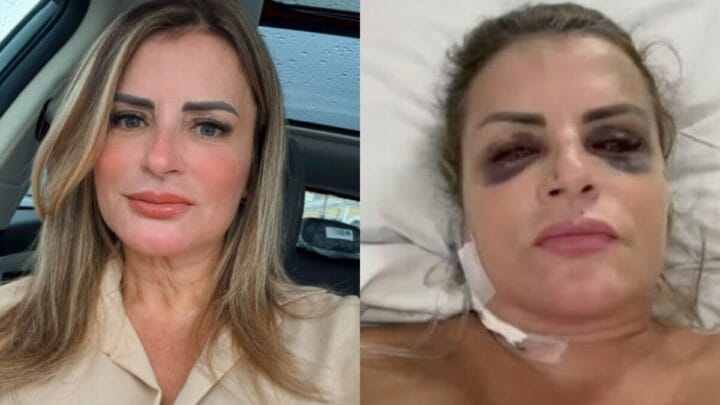 "Sentimento de impotência" diz mulher que ficou gravemente ferida após ser atropelada e arrastada no litoral de SC