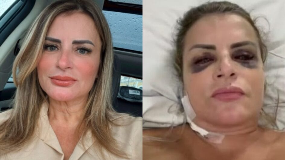 "Sentimento de impotência" diz mulher que ficou gravemente ferida após ser atropelada e arrastada no litoral de SC