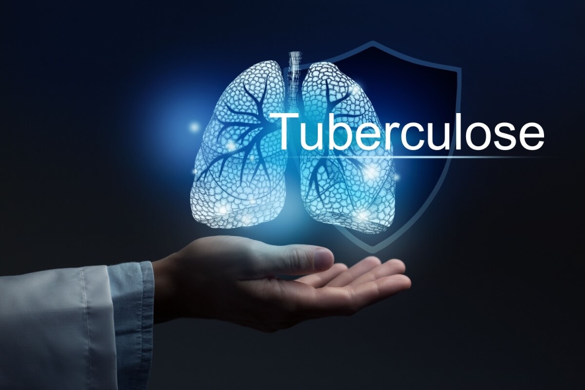 A tuberculose é uma doença infecciosa que afeta principalmente os pulmões (Imagem: mi_viri | Shutterstock)