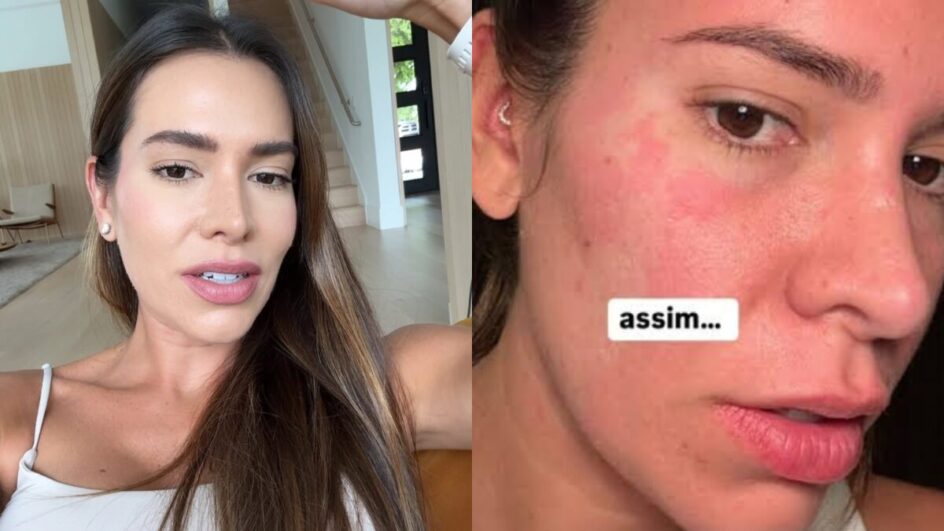 A ex-BBB Adriana Sant’Anna revelou nas redes sociais que tem intolerância à histamina