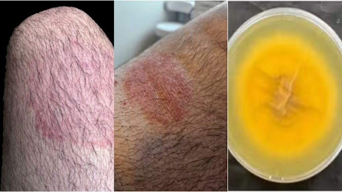 O que se sabe sobre fungo de alta transmissão registrado pela primeira vez no Brasil