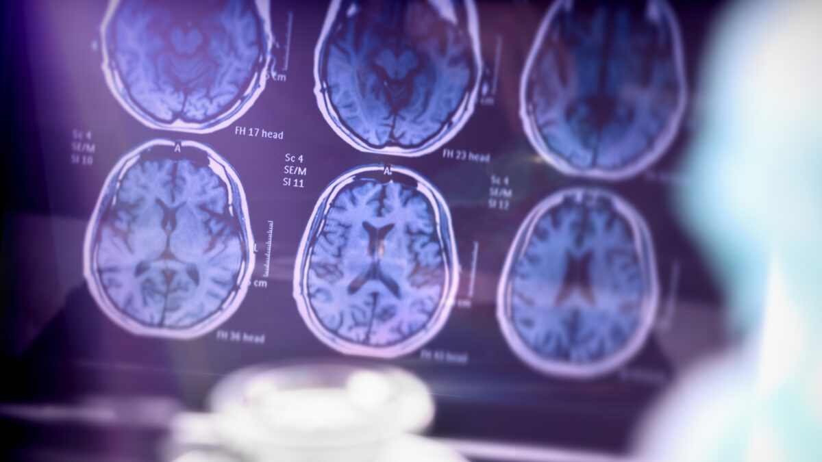 Doença de Alzheimer SUS passa a oferecer tratamento para pacientes em caso grave
