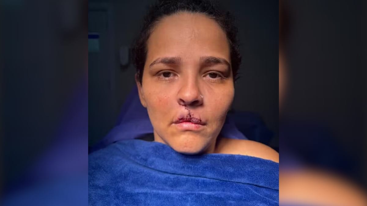 Mulher que perdeu o lábio após ser atacada pelo cão de estimação em RO tem cirurgia realizada em SC