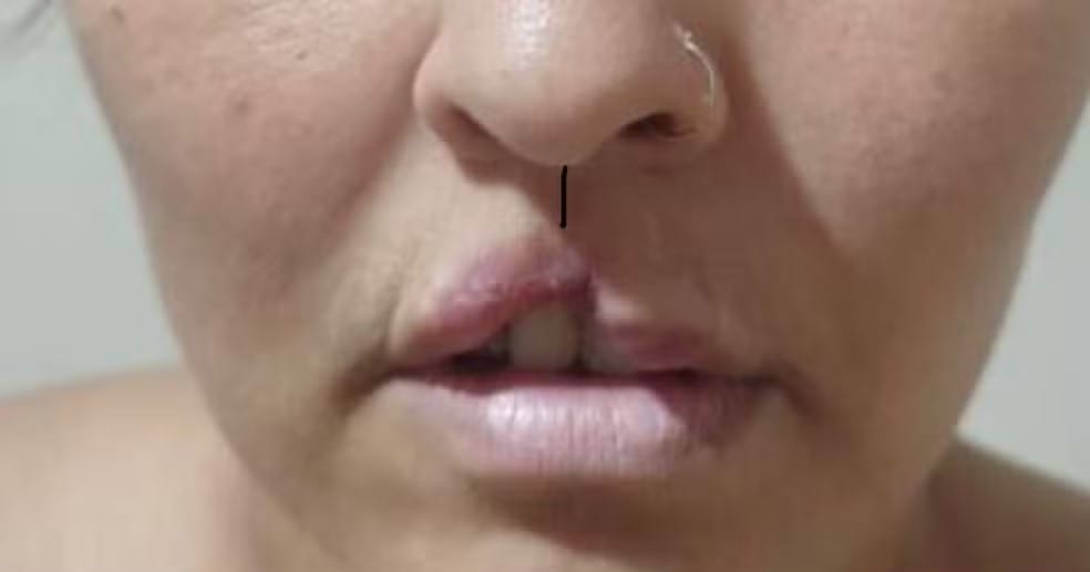 Mulher que perdeu o lábio após ser atacada pelo cão de estimação em RO tem cirurgia realizada em SC