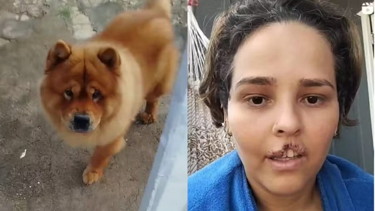 Mulher que perdeu o lábio após ser atacada pelo cão de estimação em RO tem cirurgia realizada em SC