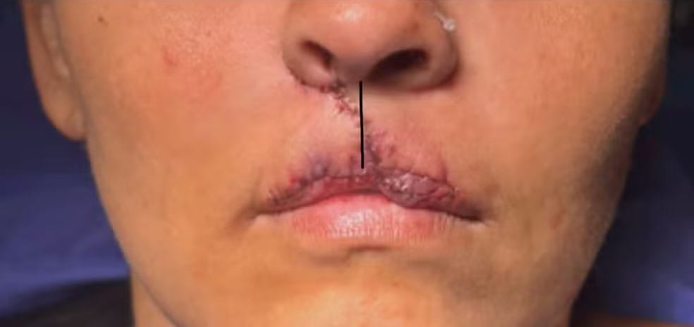 Mulher que perdeu o lábio após ser atacada pelo cão de estimação em RO tem cirurgia realizada em SC