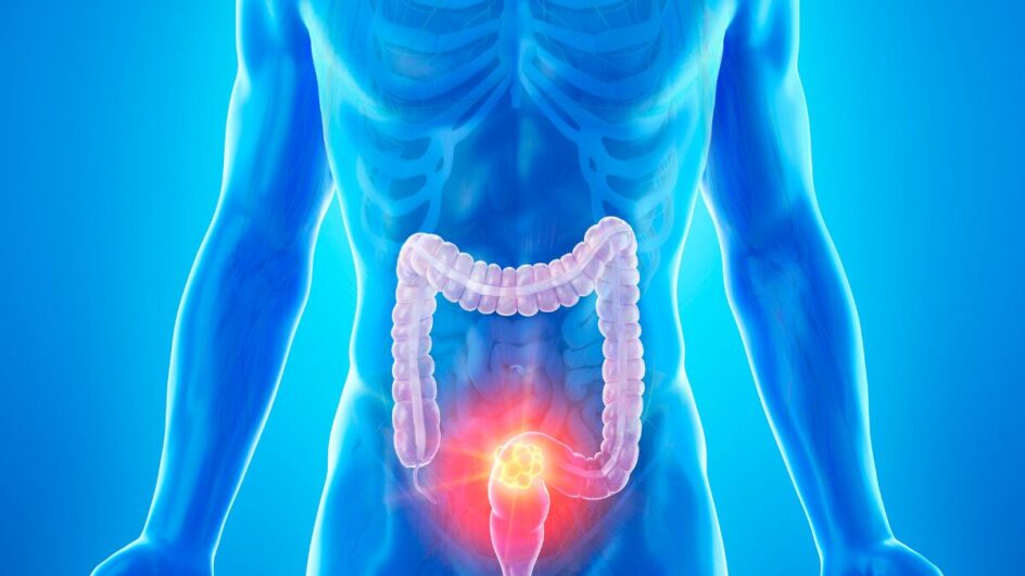 Câncer de cólon conheça os quatro sintomas (entre os jovens) que merecem atenção total