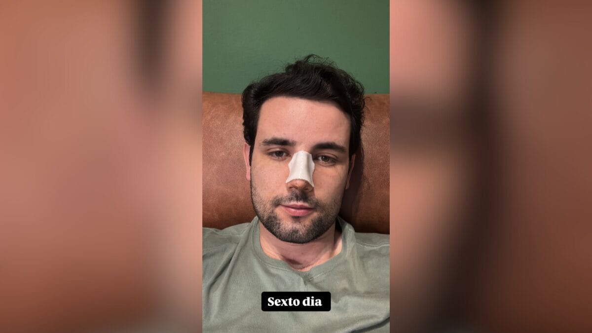 Como ficou o nariz de Matteus Amaral do BBB 24 depois da rinoplastia 