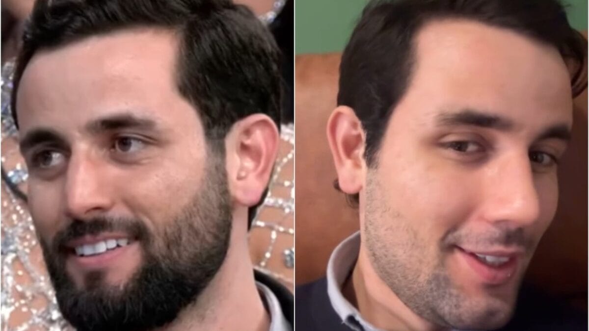 Como ficou o nariz de Matteus Amaral do BBB 24 depois da rinoplastia 