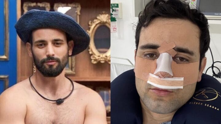 Como ficou o nariz de Matteus Amaral do BBB 24 depois da rinoplastia (7)