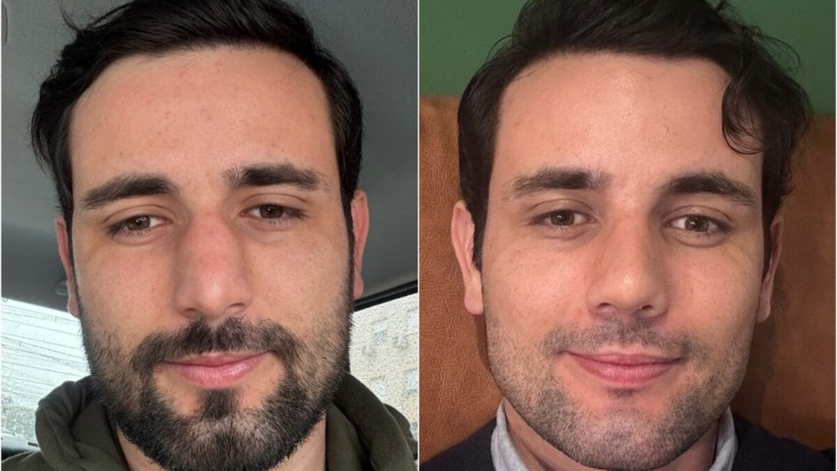 Como ficou o nariz de Matteus Amaral do BBB 24 depois da rinoplastia 