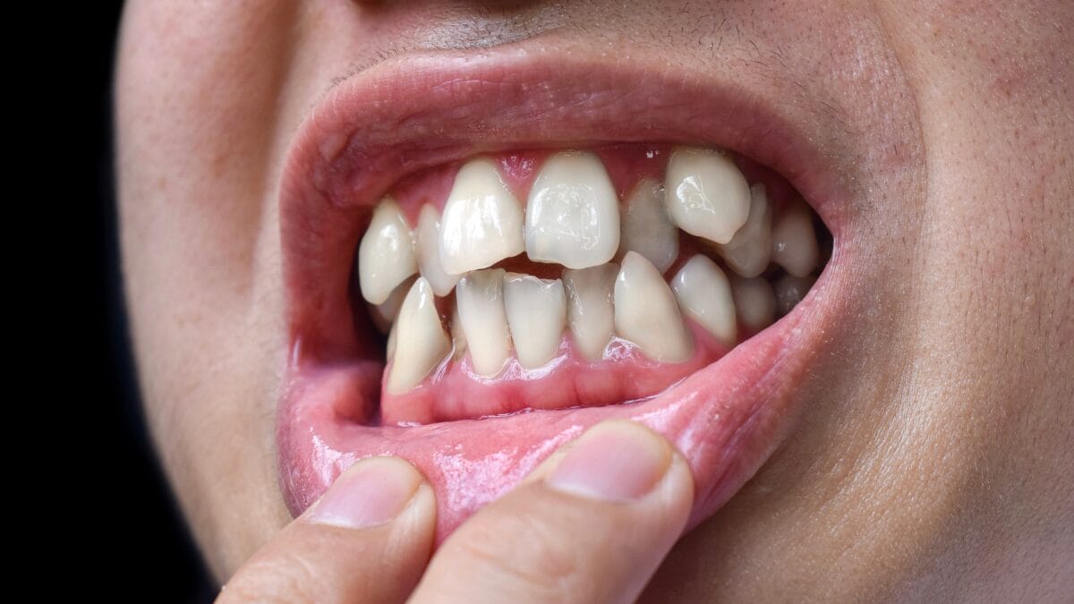Descubra como a falta de higiene bucal afeta sua saúde; evite a perda de dentes com cuidados simples e eficazes