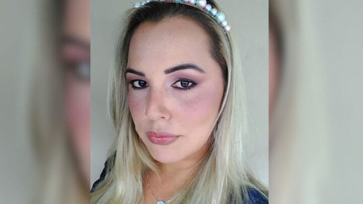 Após sofrer uma inflamação seis meses depois da aplicação do PMMA, Mariana precisou retirar o lábio superior (Foto Redes sociais, Reprodução)