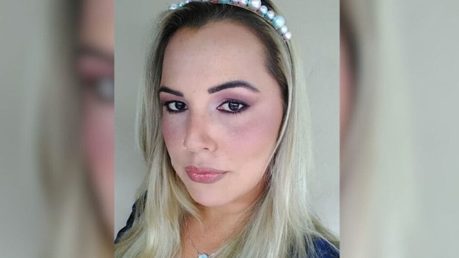 Após sofrer uma inflamação seis meses depois da aplicação do PMMA, Mariana precisou retirar o lábio superior (Foto Redes sociais, Reprodução)