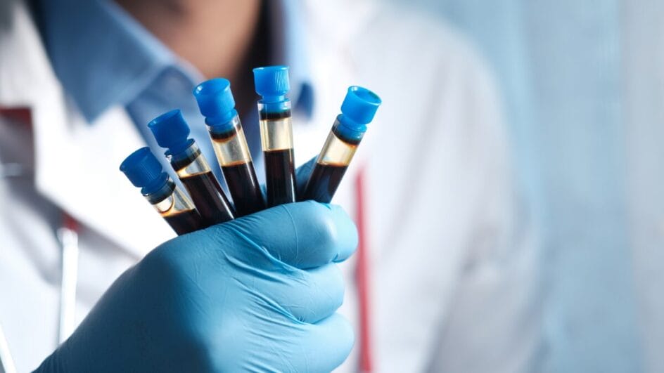 Exame de sangue detecta câncer de cabeça e pescoço até 10 anos antes dos sintomas