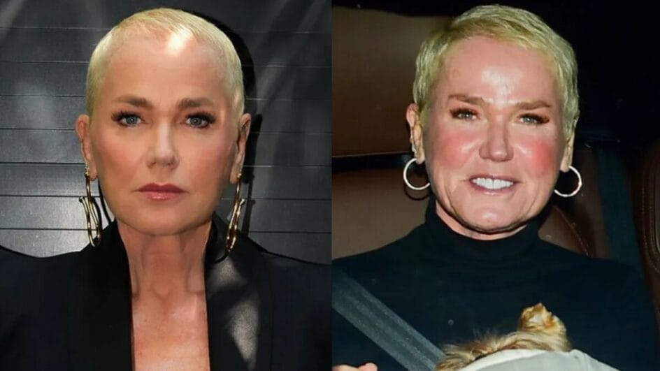 Xuxa transplante capilar